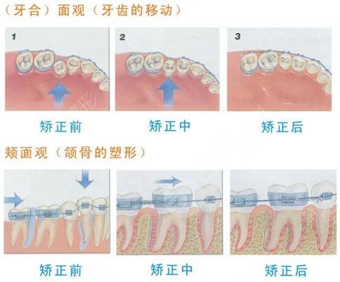 牙齿矫正过程