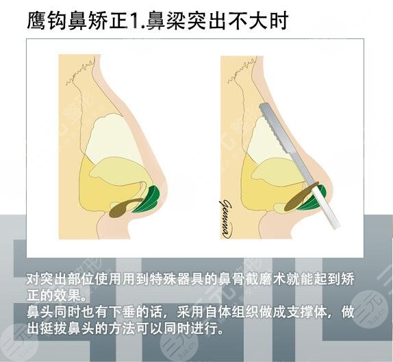 怎样改变鹰钩鼻子?鹰钩鼻怎么矫正呢?