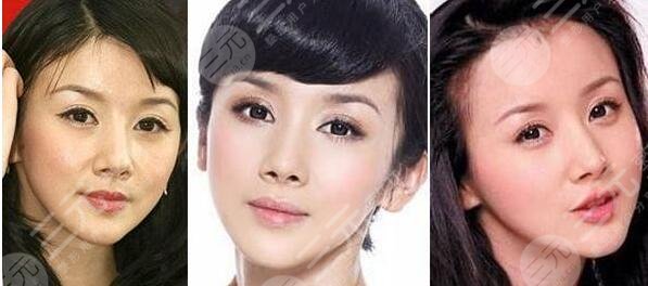 孙菲菲整容前后整容变化对比详细解析到底整了哪