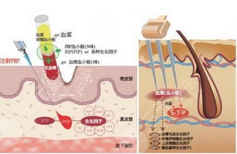 pse微针植发