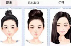 高分子埋线双眼皮是什么？优缺点解析+果图分享，必看攻略！