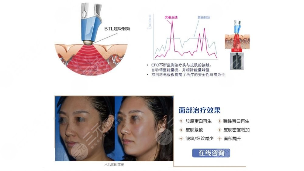 磁波内雕和热玛吉哪个好