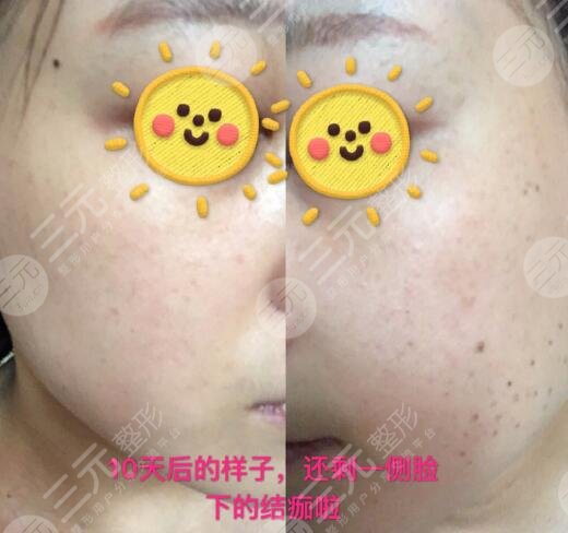 激光祛斑反黑图片