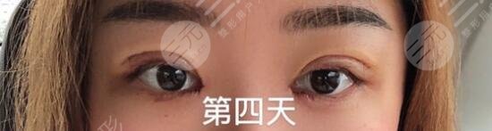 术后的一周