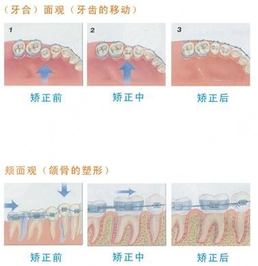 佩戴牙套需要注意的事项