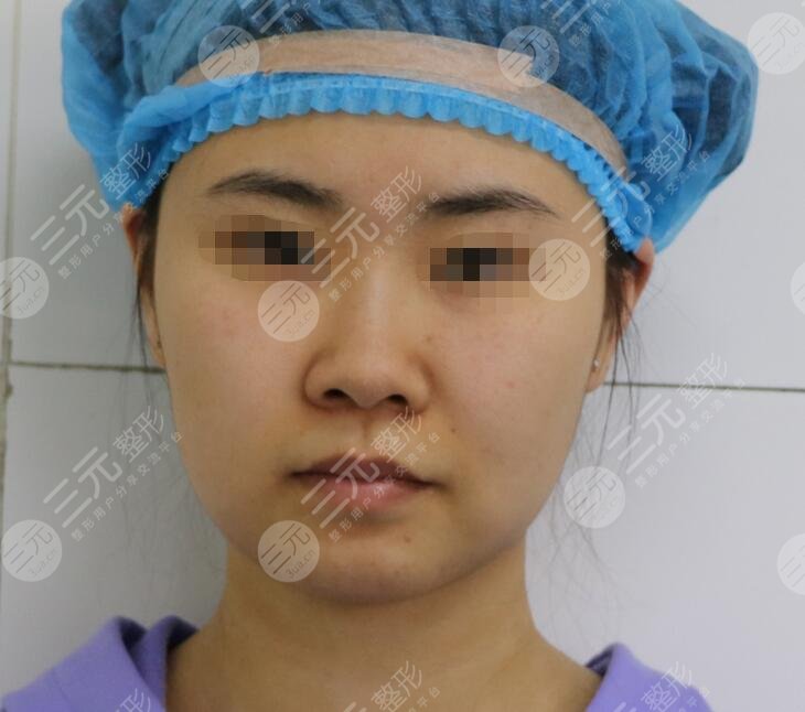 脸部抽脂前后对比照分享,肉肉脸的救星,终于精致了!