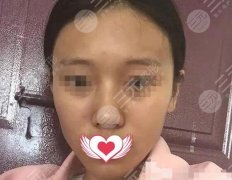 北京亚楠容悦面部脂肪填充案例，小脸蛋砰起来了