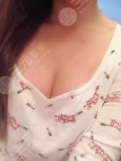 北京世熙丁砚江医生做的脂肪丰胸案例 记录从A到C