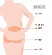 吸脂减肥术的步骤是怎样的？