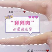 揭秘：做吸脂手术有多疼？有什么缓解疼痛的方法？