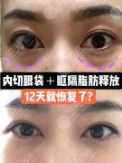 解答：关于手术祛除眼袋的常见方法和误区