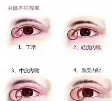 如何避免开眼角留疤?