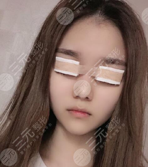 王佳琦双眼皮术前术后两个人，果真实自然！