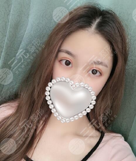 王佳琦双眼皮术前术后两个人，果真实自然！