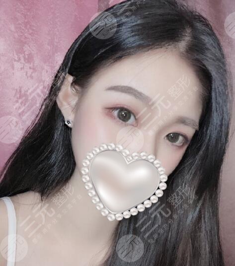 王佳琦双眼皮术前术后两个人，果真实自然！