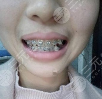 广州时光侯振杰医生怎么样？牙齿矫正果真是太好了！