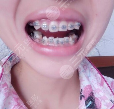 广州时光侯振杰医生怎么样？牙齿矫正果真是太好了！