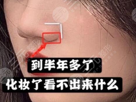 缩小鼻头后
