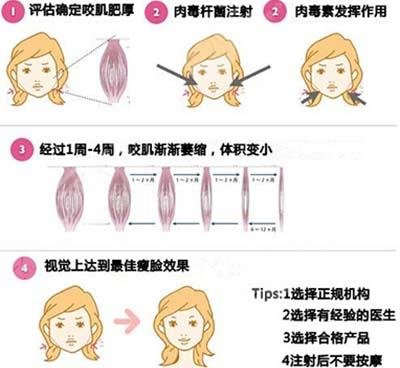 注射瘦脸功果是什么？