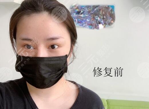 北京八大处双眼皮修复专家案例