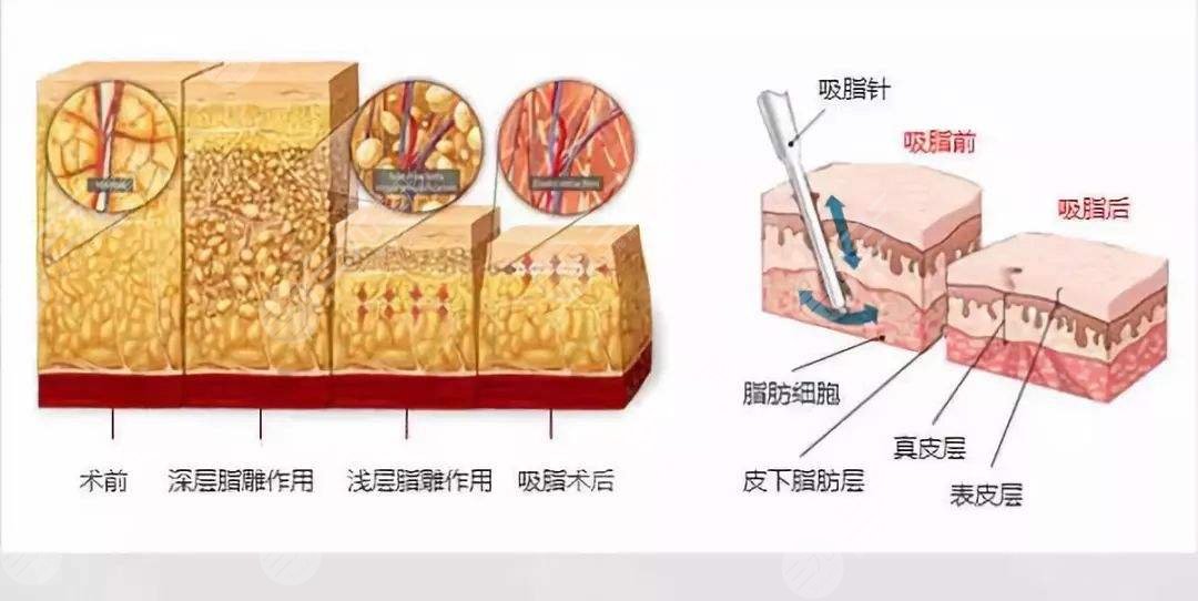 怎么样溶脂吸脂