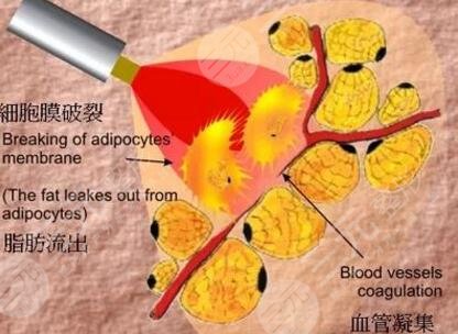 怎么样溶脂吸脂