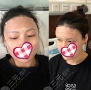 北京世熙脂肪填充全脸术后2个月，脸型改良很明X！