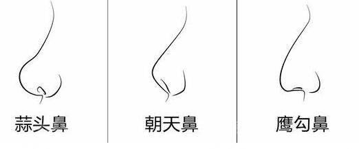矫正鹰钩鼻