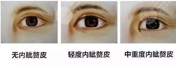 开眼角手术过程展示图片?