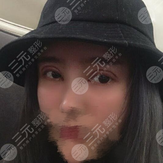 双眼皮拆线后