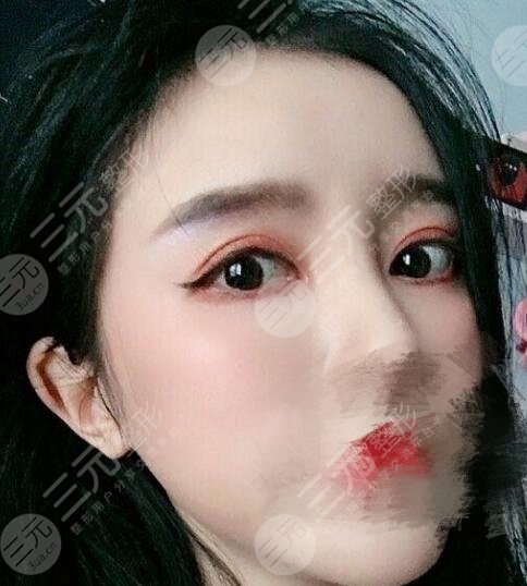 双眼皮术后一个月