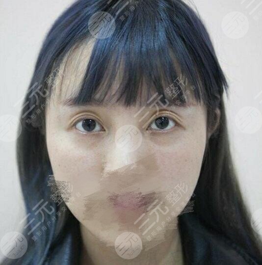 双眼皮修复前