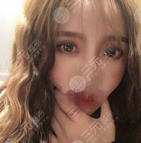 双眼皮术后