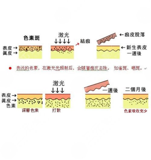 激光去黑眼圈多少钱？有果吗？来瞧瞧价格和果图，包你心动！