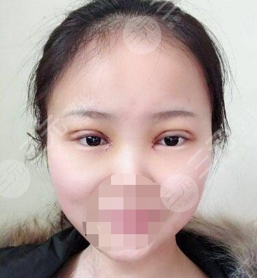 新疆医大第一附院割双眼皮案例