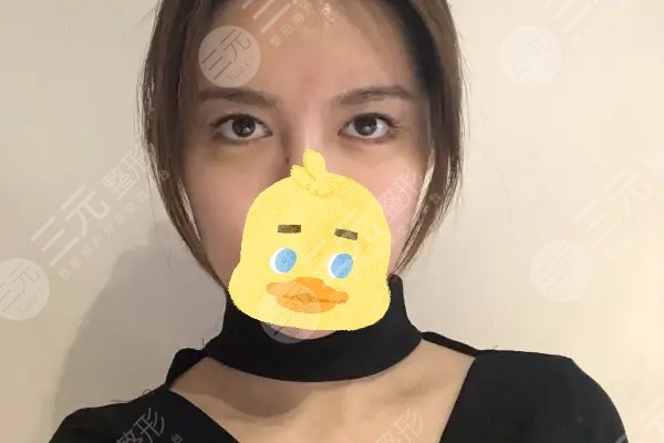 8mm双眼皮手术案例