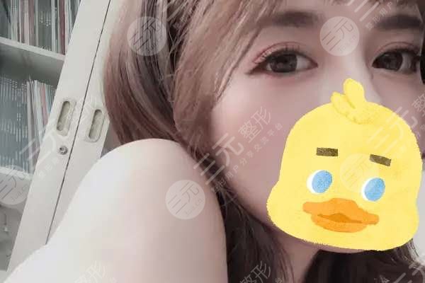 8mm双眼皮手术案例