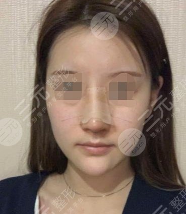 公开：西京医院微整形价目表，隆鼻手术果图展示!