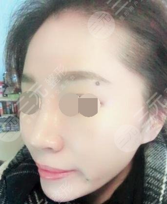 微创面部除皱的价格
