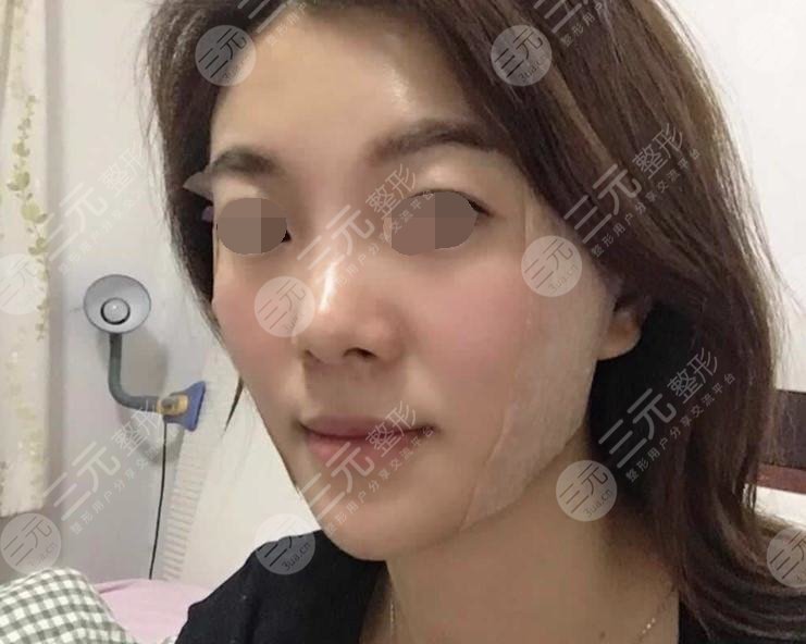 微创面部除皱的价格