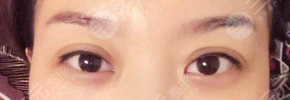 生物焊接双眼皮的真相，生物焊接双眼皮是什么原理？