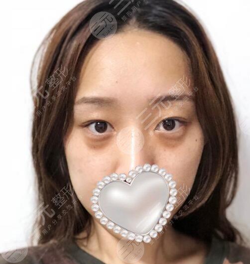激光去黑眼圈案例