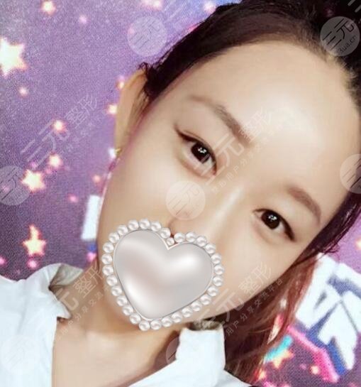 激光去黑眼圈案例
