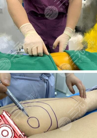 吸脂瘦腿的方法有哪些吸脂瘦腿注意事项须知