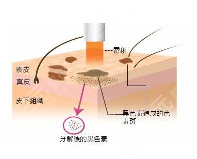 激光祛斑