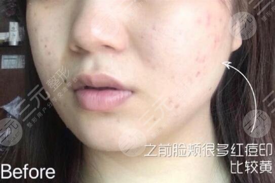 黑脸娃娃嫩肤体验前