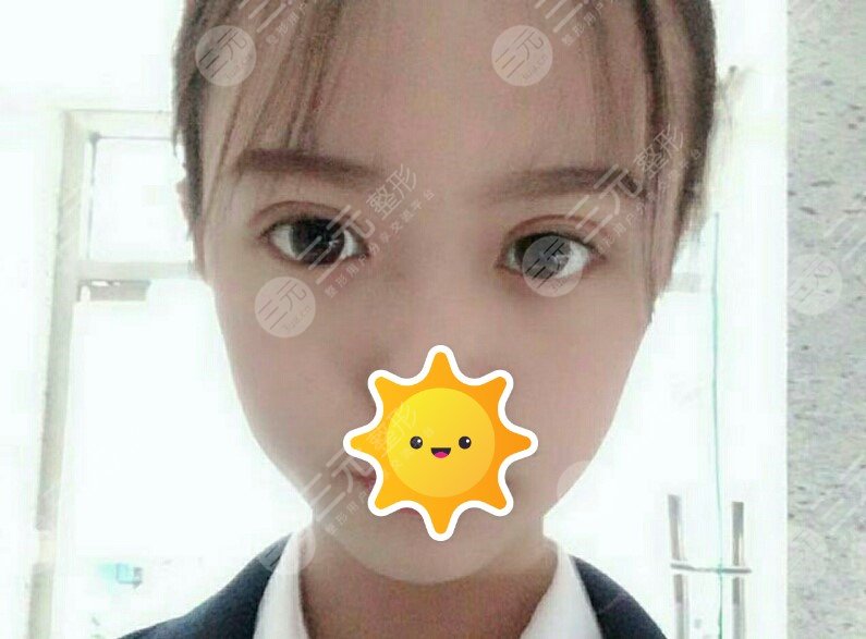 松原齐飞整形报价表,附双眼皮案例,让眼睛更美!