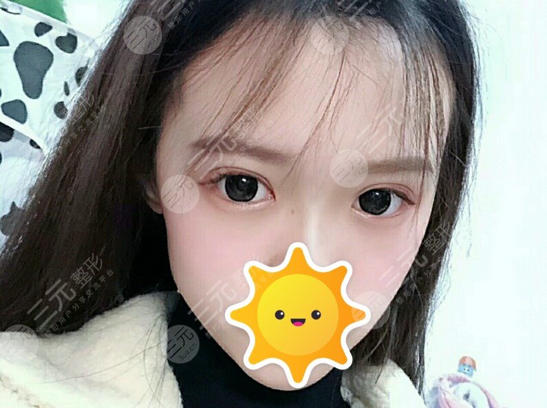 松原齐飞整形报价表,附双眼皮案例,让眼睛更美!