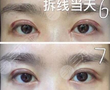 外眼角开大了图片
