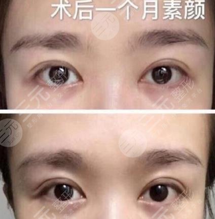 外眼角开大了图片